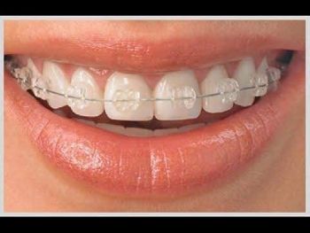 Ceramic Bracket Kit